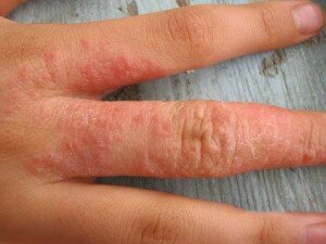 Аллергическая сыпь на руках