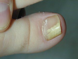 Грибок на ногте большого пальца 