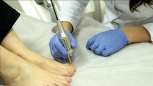 лазерное лечение грибка ногтей