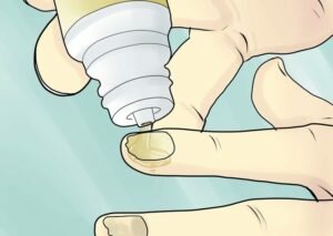 Нанесение препарата от грибка на ногти